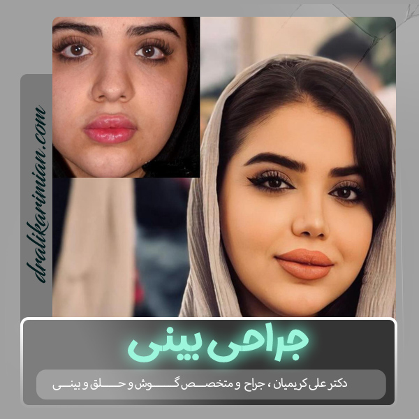 جراحی بینی در کاشان با دکتر علی کریمیان